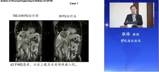 重庆海扶医院张炼院长出席聚焦超声消融手术临床应用示范中心授牌仪式