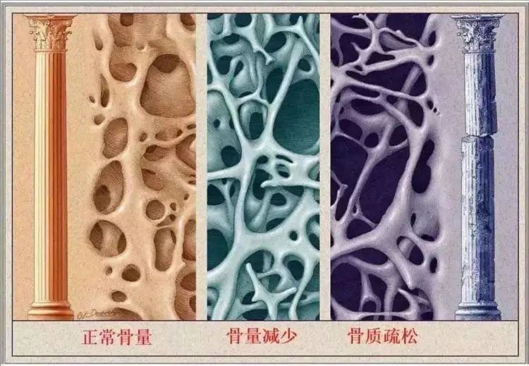 每天两瓶可乐，年轻男子患上骨质疏松症