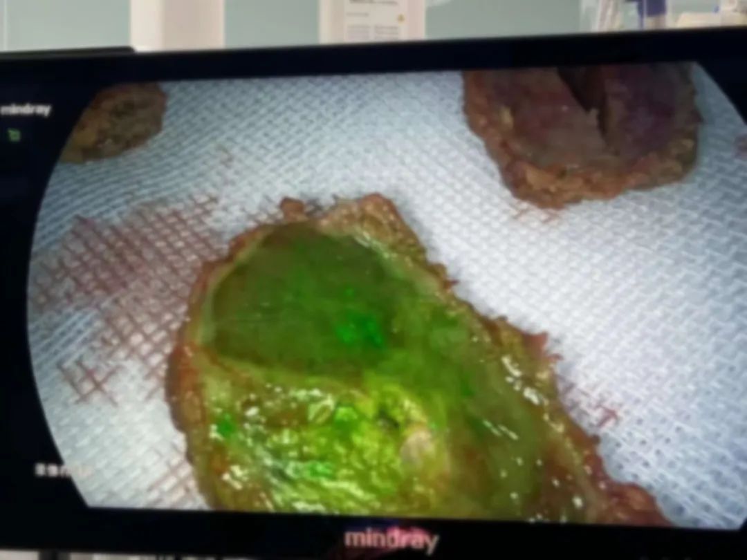 给肿瘤穿上「荧光衣」——东阳市人民医院成功开展荧光导航肝癌切除术