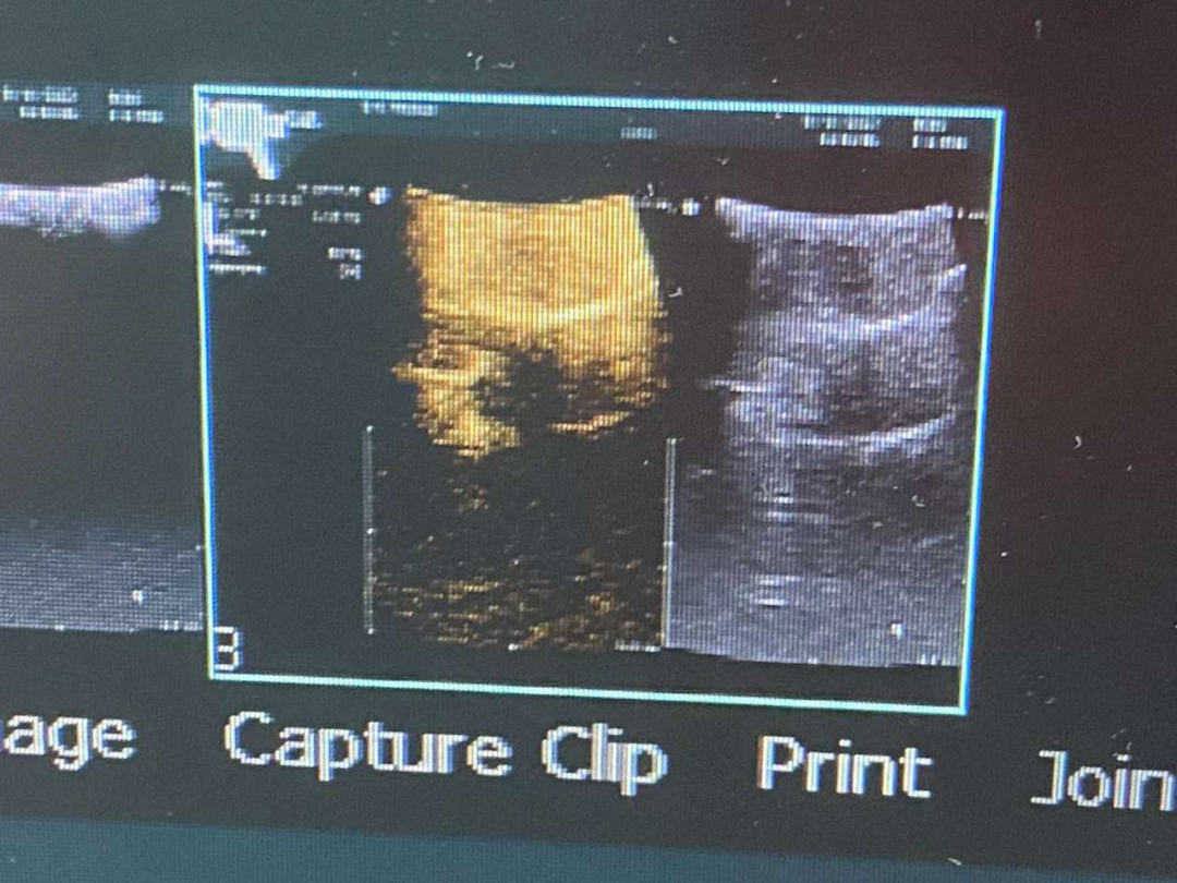 给肿瘤穿上「荧光衣」——东阳市人民医院成功开展荧光导航肝癌切除术