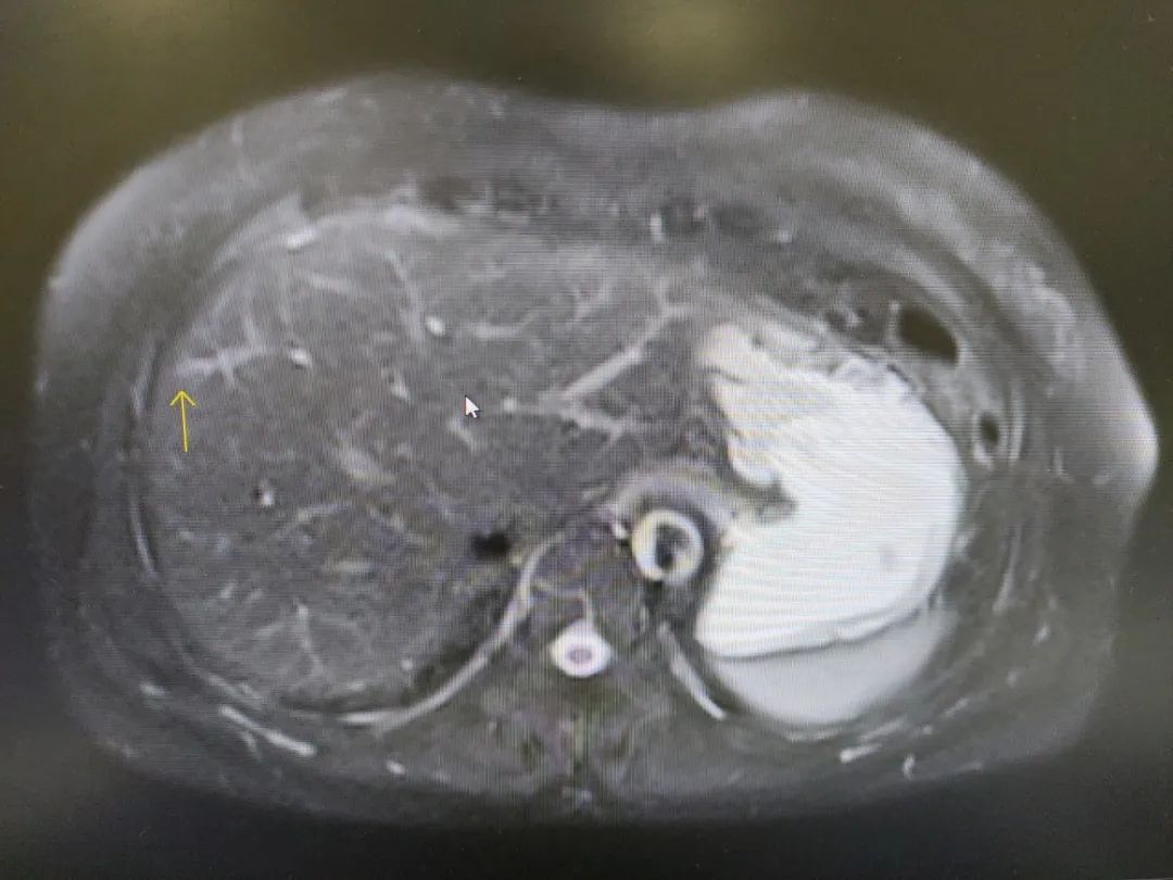 给肿瘤穿上「荧光衣」——东阳市人民医院成功开展荧光导航肝癌切除术