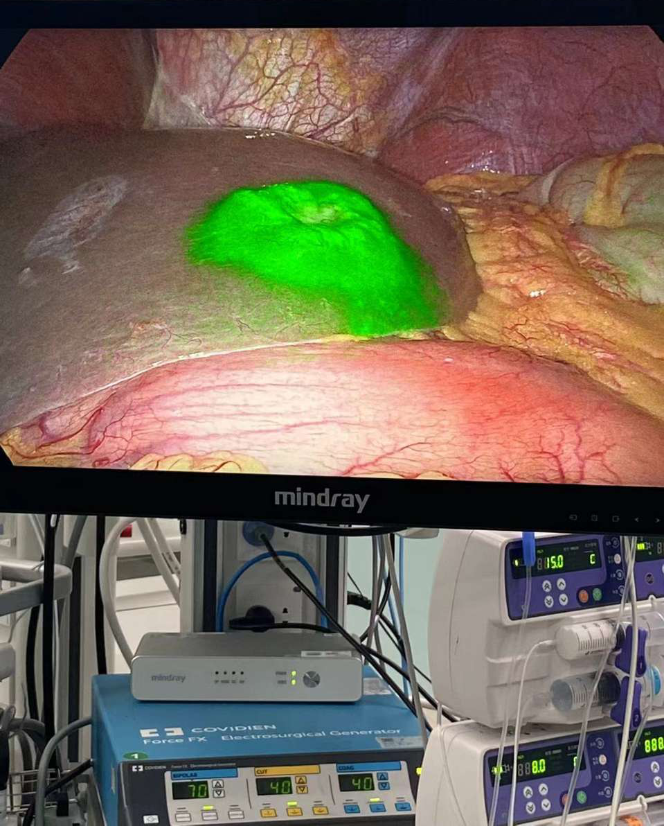 给肿瘤穿上「荧光衣」——东阳市人民医院成功开展荧光导航肝癌切除术