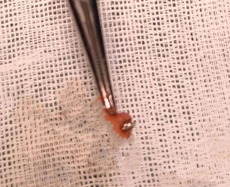 惊!一岁女童在家中被水银体温计插入腋下