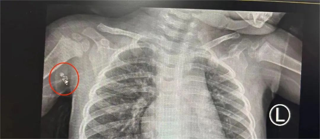 惊!一岁女童在家中被水银体温计插入腋下