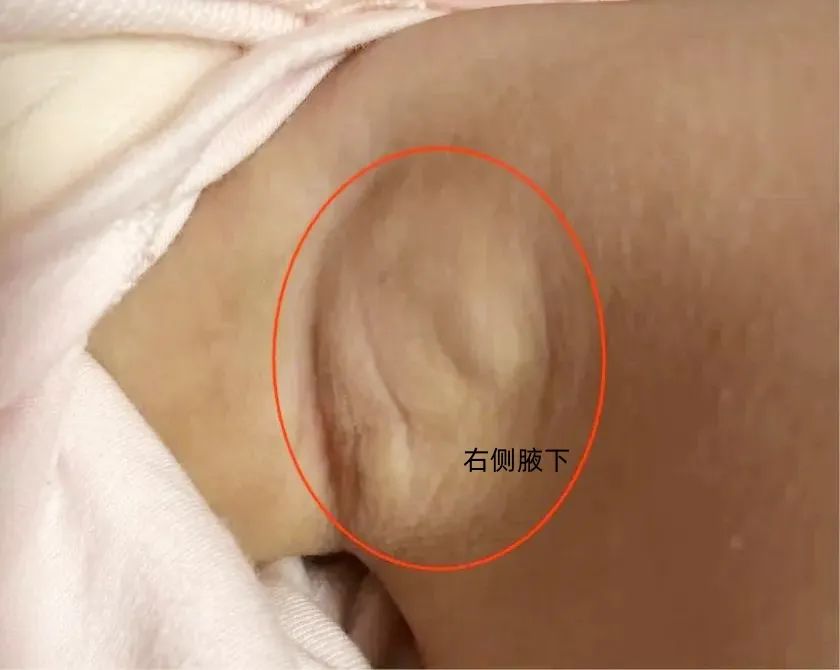 惊!一岁女童在家中被水银体温计插入腋下