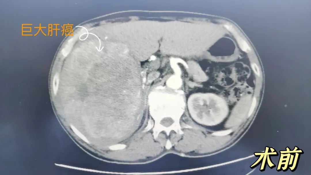 18 cm！小南瓜一般的肝脏巨大肿瘤！句容市人民医院普外科成功切除！