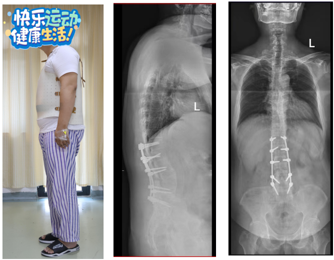 不死的癌症——强直性脊柱炎