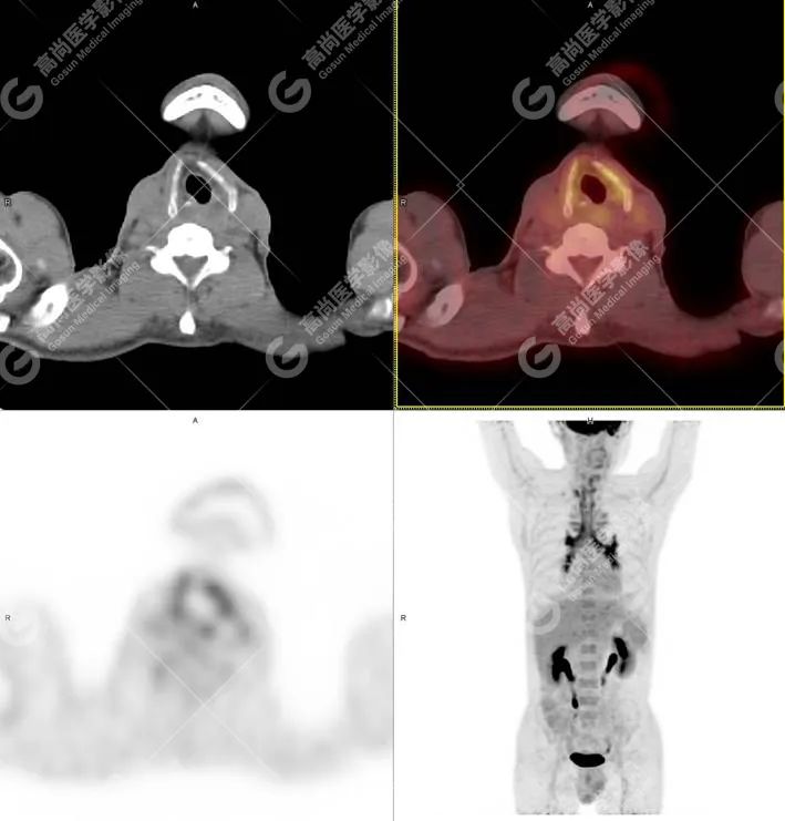 【高尚病例】这个罕见病,PET/CT 一目了然!
