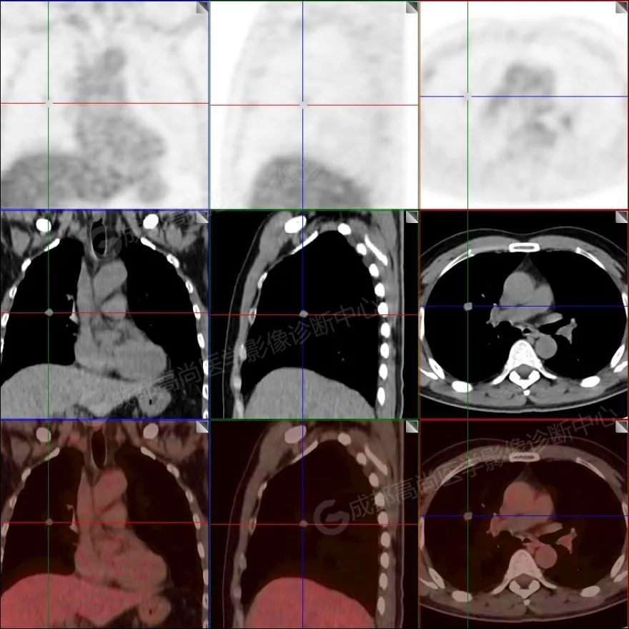 【高尚病例】男子体检出肺结节 3 月余，被诊断肺软骨源性错构瘤 1 例