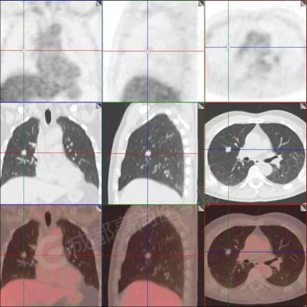 【高尚病例】男子体检出肺结节 3 月余，被诊断肺软骨源性错构瘤 1 例