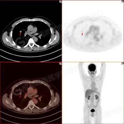 【高尚病例】男子体检出肺结节 3 月余，被诊断肺软骨源性错构瘤 1 例