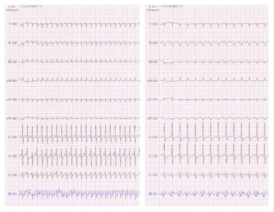 22 天宝宝一分钟心动 300 次!淮安市第一人民医院食道调博成功救治!