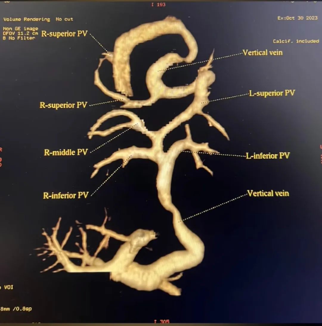 高难度心脏手术,让 9 日龄男婴错位心脏血液循环恢复正常