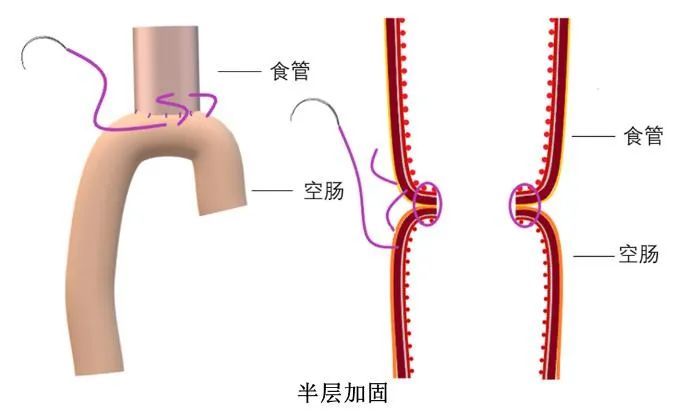 解决胃癌手术安全难题 河南省肿瘤医院原创技术临床研究登上「中华牌」期刊