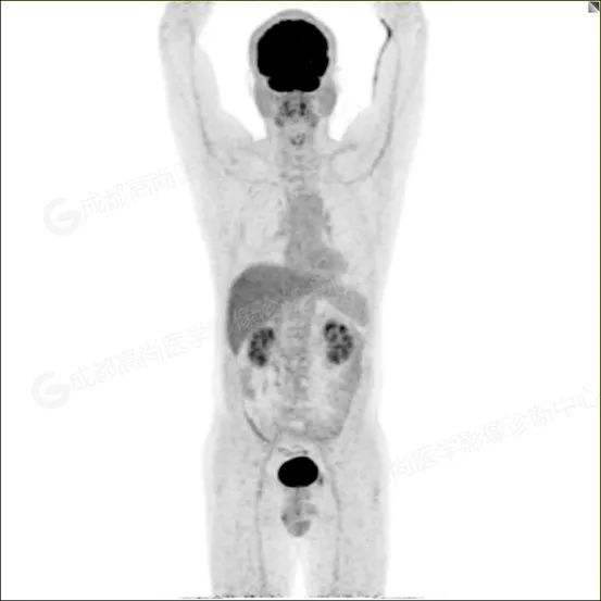 【高尚病例】男子体检出肺结节 3 月余，被诊断肺软骨源性错构瘤 1 例