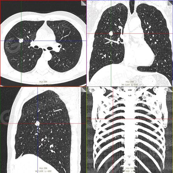 【高尚病例】男子体检出肺结节 3 月余，被诊断肺软骨源性错构瘤 1 例
