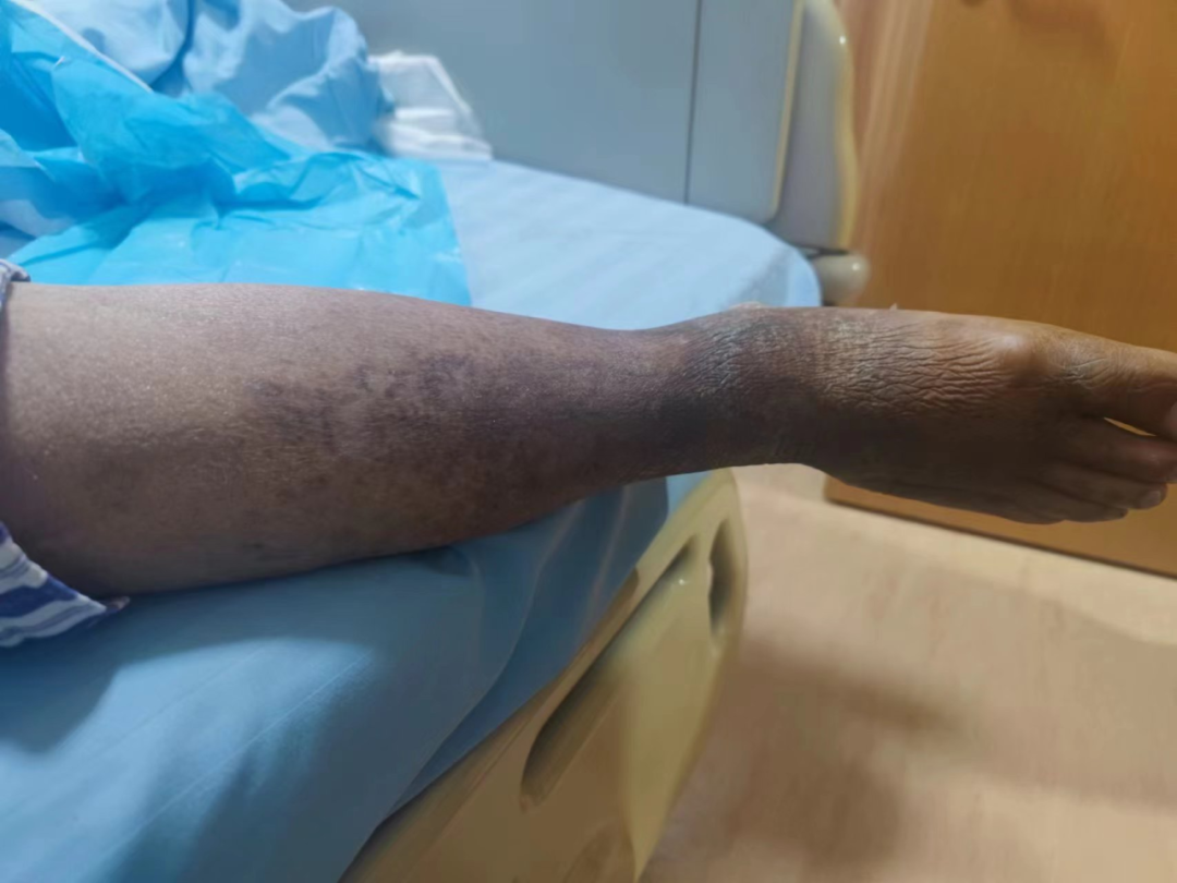 烂掉右脚的他昏迷 3 小时！医生：这种并发症严重伤及大脑