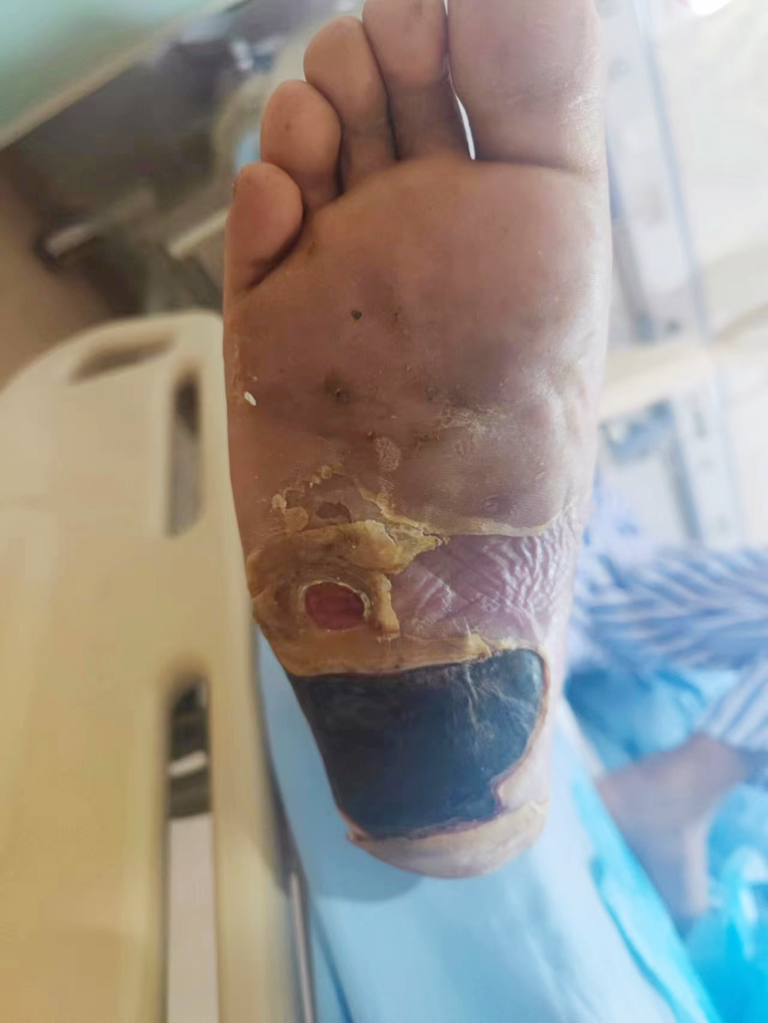 烂掉右脚的他昏迷 3 小时！医生：这种并发症严重伤及大脑