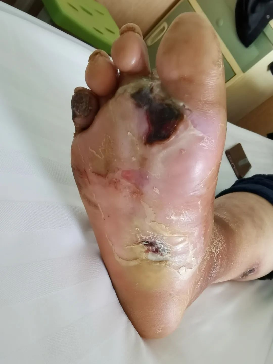 足底大面积坏死的糖尿病足患者在延安大学附属医院成功保肢