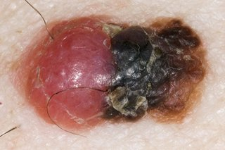 身上的痣到底要不要去掉？如果符合这 5 点要重视，可能恶化