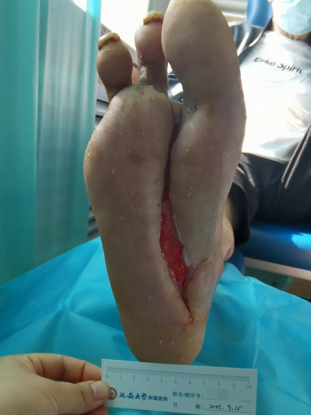 足底大面积坏死的糖尿病足患者在延安大学附属医院成功保肢