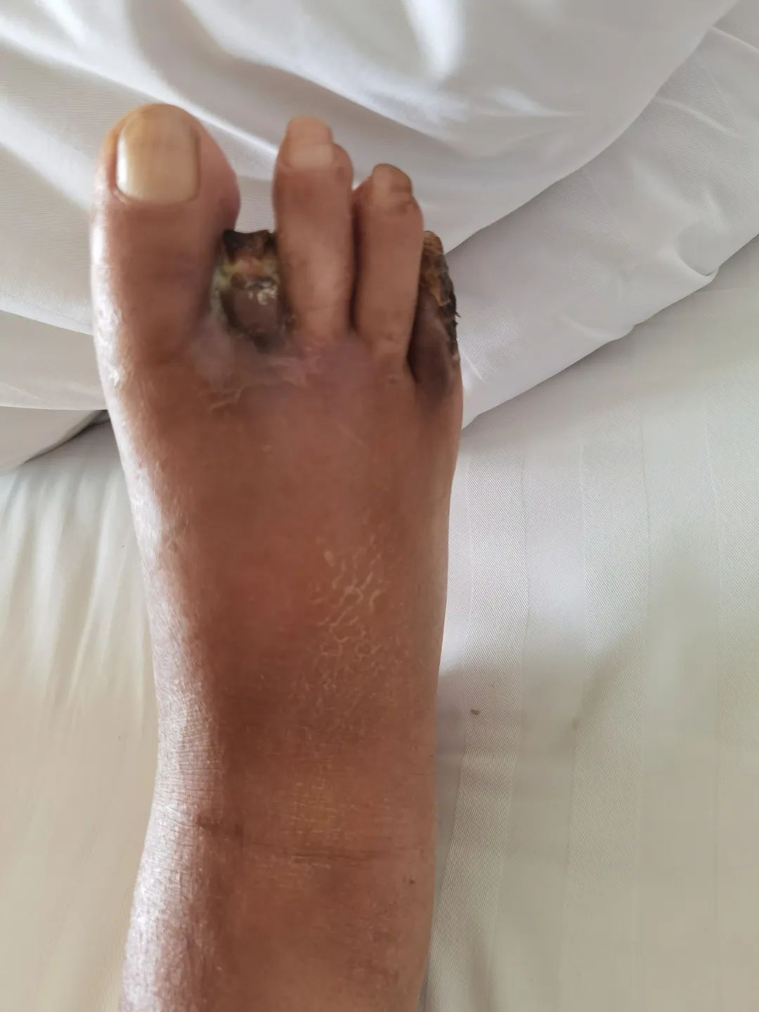 足底大面积坏死的糖尿病足患者在延安大学附属医院成功保肢