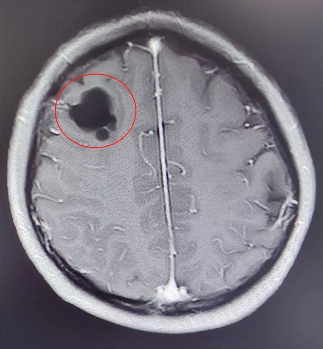 張登介紹,「張女士出現多次暈倒,主要是因為她的大腦右側額葉部位長了