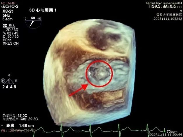 走在前列丨青岛大学附属医院心血管外科团队成功开展经导管二尖瓣钳夹术