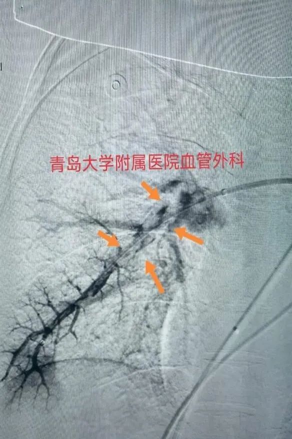 精湛技术丨青岛大学附属医院血管外科团队成功救治肺栓塞患者