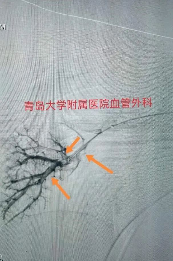 精湛技术丨青岛大学附属医院血管外科团队成功救治肺栓塞患者