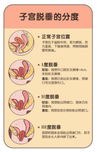 轻症的子宫脱垂患者,一般没有明显的不适症状