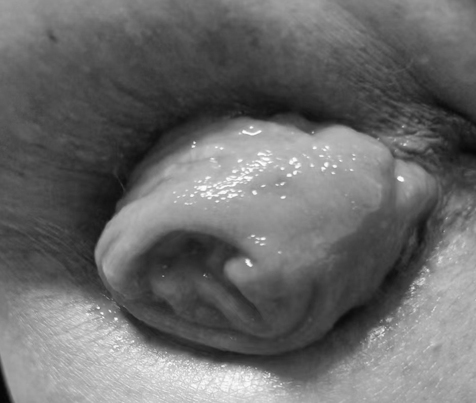 肠子老往外掉!84 岁老人彻底慌了!