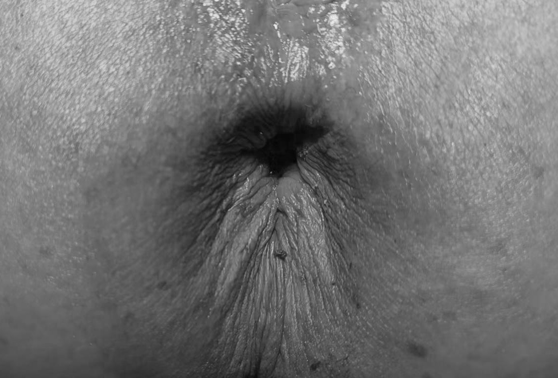 肠子老往外掉!84 岁老人彻底慌了!