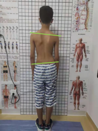 脊柱侧弯？这份青少年脊柱健康的守护指南请查收