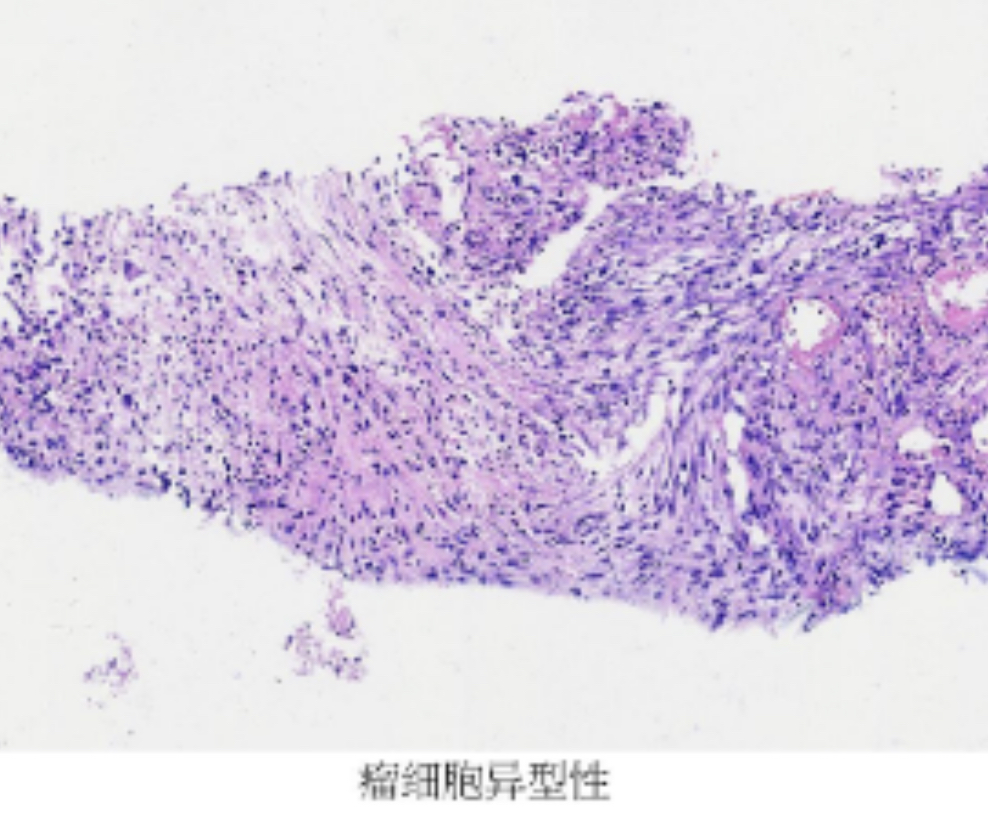 重庆市黔江中心医院血液肿瘤科成功开展 CT 引导下经颅骨脑肿瘤穿刺技术
