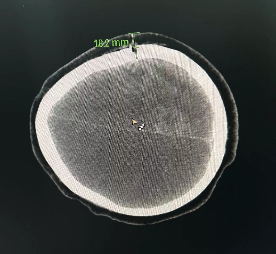 重庆市黔江中心医院血液肿瘤科成功开展 CT 引导下经颅骨脑肿瘤穿刺技术