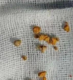 多喝水尿不出结石！这 3 个「雷点」不少人踩坑，教你一招远离尿路结石