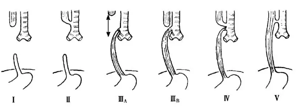 刚出生的宝宝只会吐泡泡，无法进食……