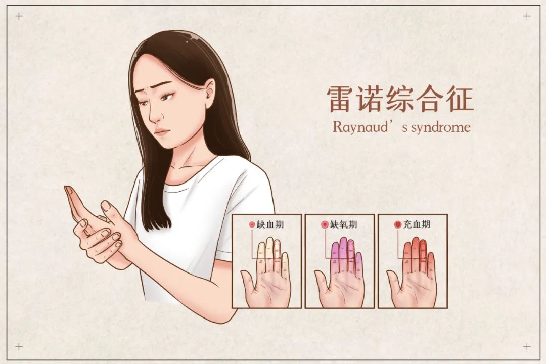 关于红斑狼疮，这些知识一定要知道！