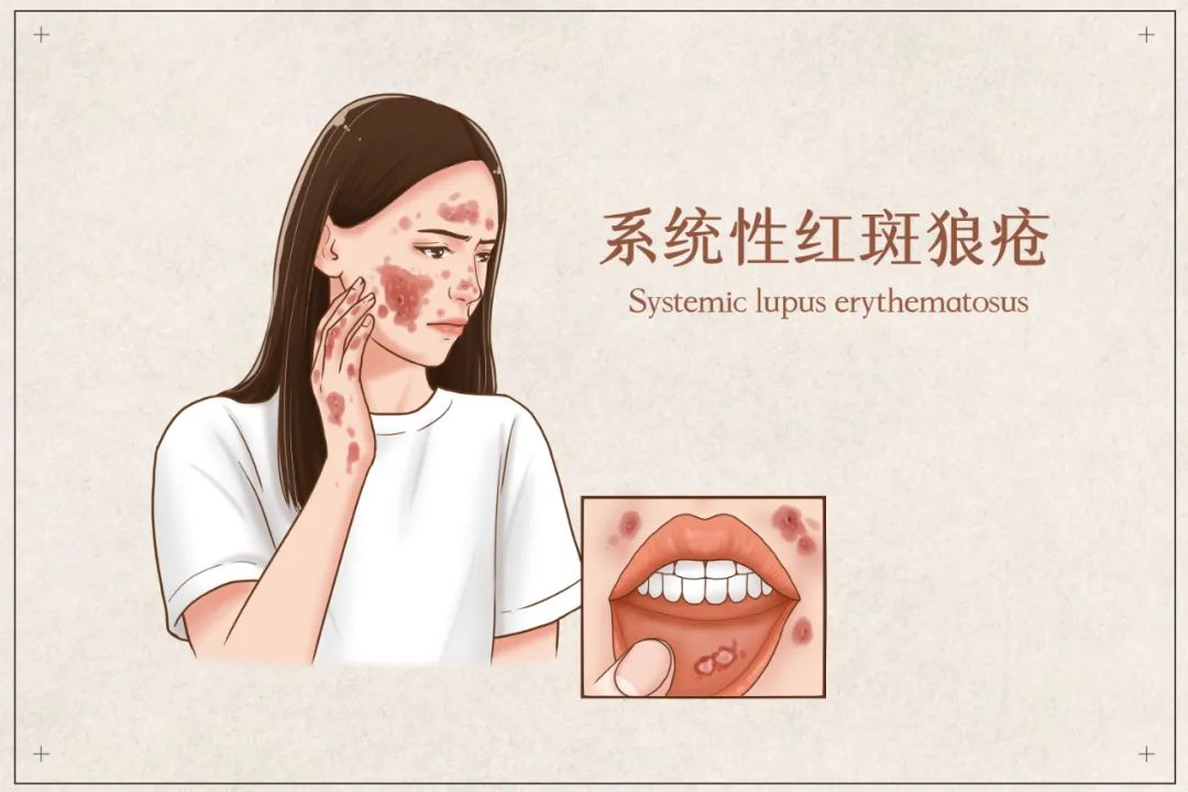 关于红斑狼疮，这些知识一定要知道！
