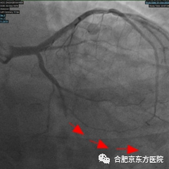 合肥京东方医院科普:大降温!心梗说来就来,感冒、寒冷是潜在诱因