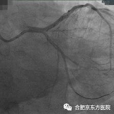 合肥京东方医院科普:大降温!心梗说来就来,感冒、寒冷是潜在诱因