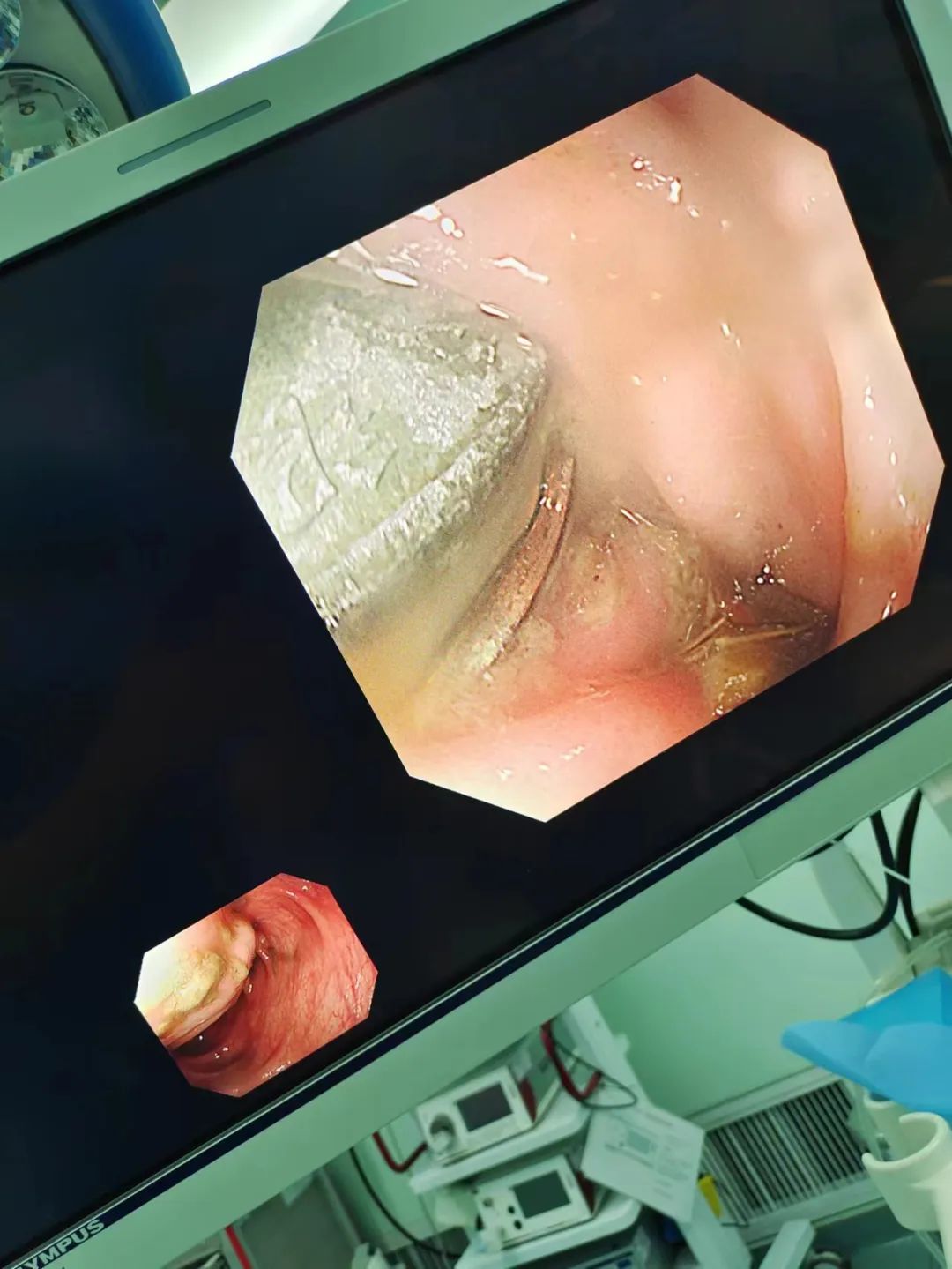 误吞订书针,扎进胃里!电池、硬币、铜葫芦... 医生从身体里都取出过啥