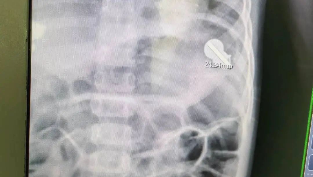 误吞订书针,扎进胃里!电池、硬币、铜葫芦... 医生从身体里都取出过啥