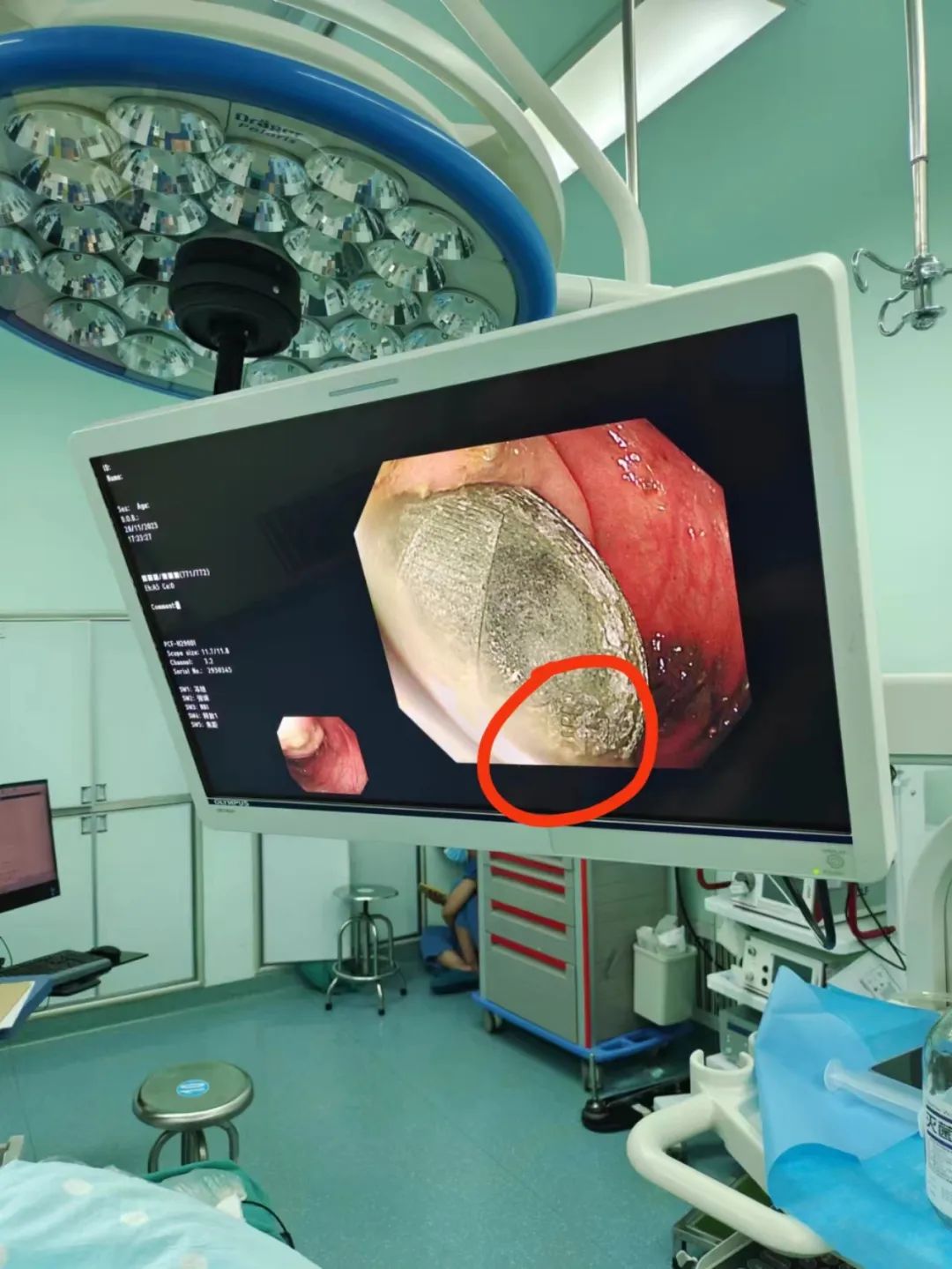 误吞订书针,扎进胃里!电池、硬币、铜葫芦... 医生从身体里都取出过啥