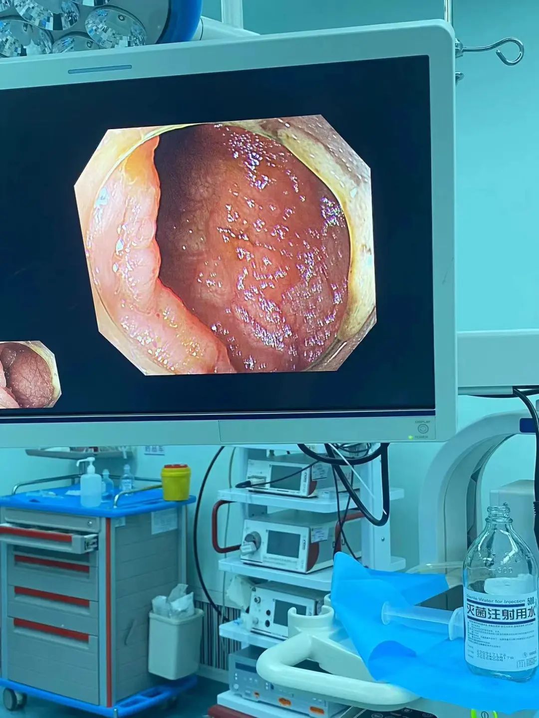 误吞订书针,扎进胃里!电池、硬币、铜葫芦... 医生从身体里都取出过啥