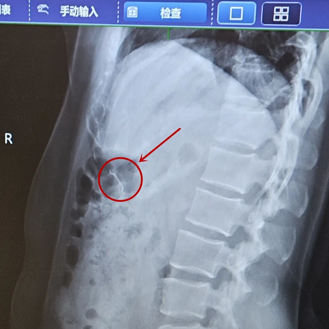 误吞订书针,扎进胃里!电池、硬币、铜葫芦... 医生从身体里都取出过啥