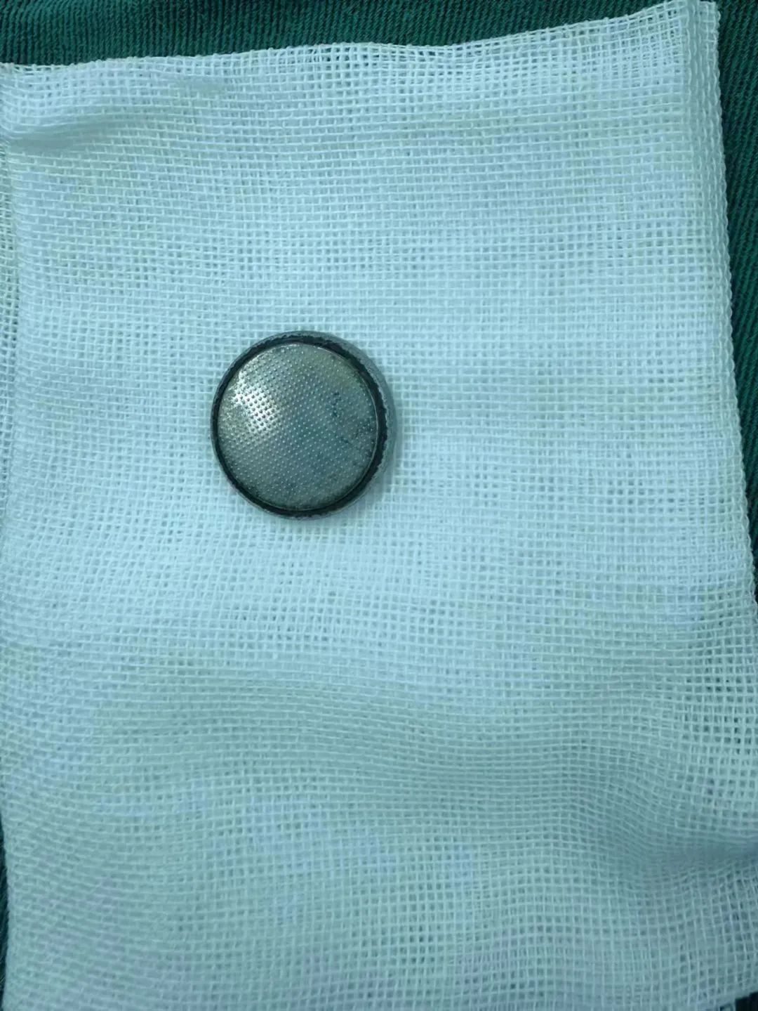 误吞订书针,扎进胃里!电池、硬币、铜葫芦... 医生从身体里都取出过啥