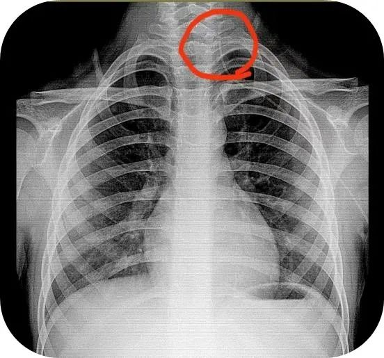 惊！ X 线胸片显示 PICC 导管到颈部了，怎么办？