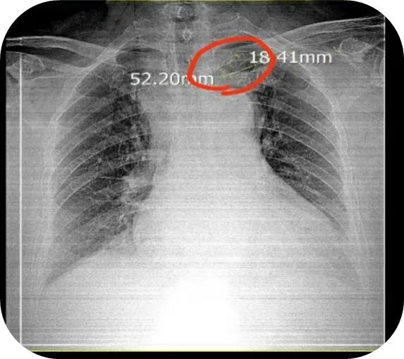 惊！ X 线胸片显示 PICC 导管到颈部了，怎么办？